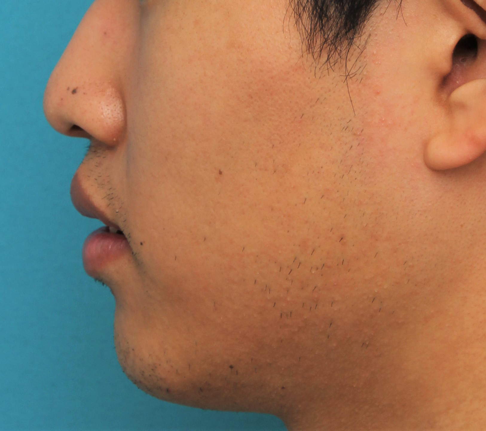 症例写真,手術で上下の唇を薄くした20代男性の症例写真,After（4ヶ月後）,ba_usuku017_b04.jpg