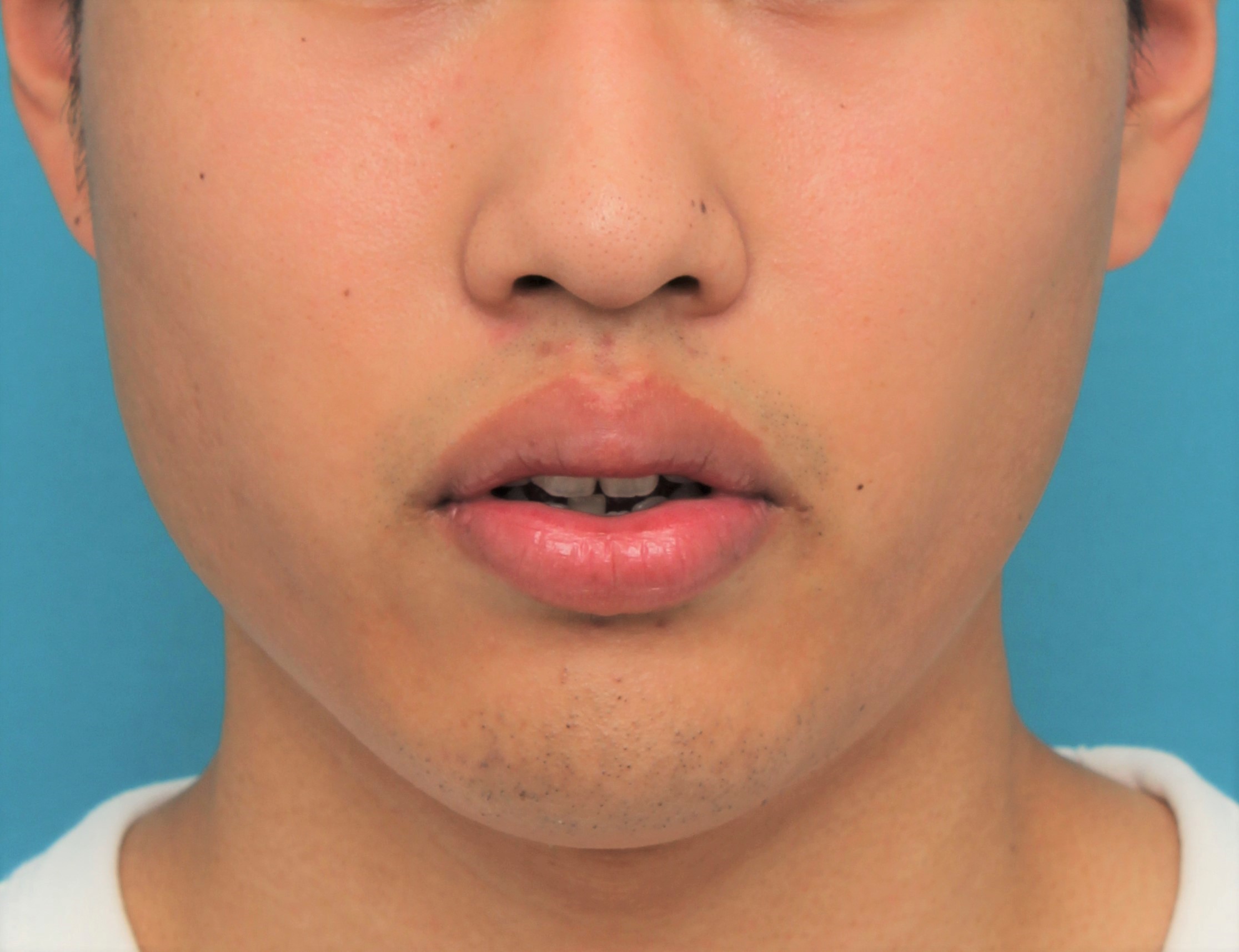 症例写真,手術で上下の唇を薄くした20代男性の症例写真,手術前,口を半開きにした状態,mainpic_usuku017b.jpg
