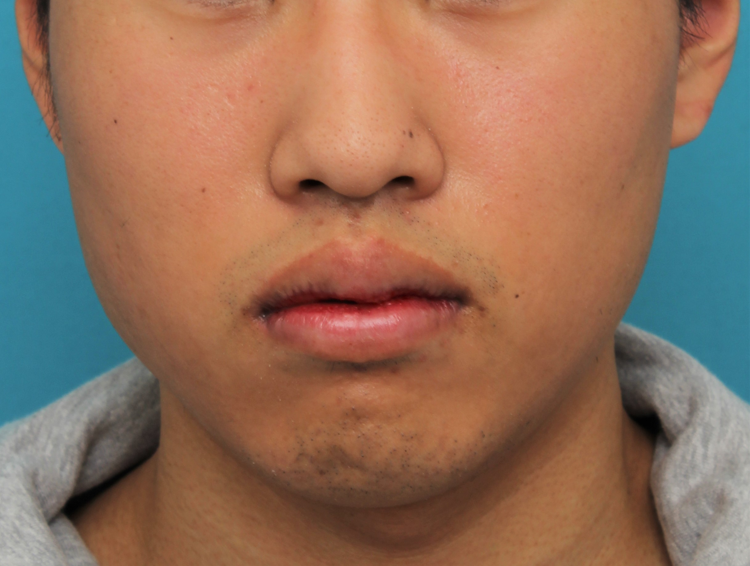 症例写真,手術で上下の唇を薄くした20代男性の症例写真,8日後,口を閉じた状態,mainpic_usuku017d.jpg