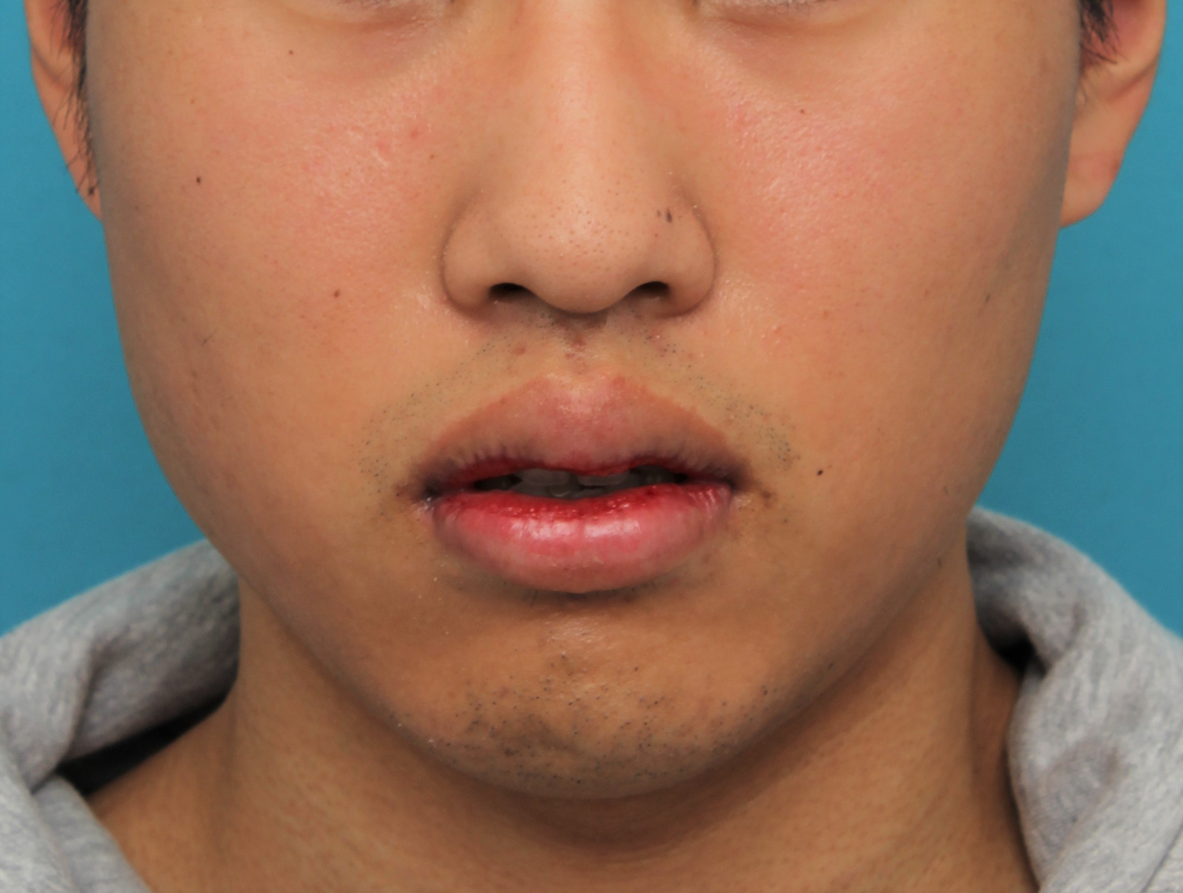 症例写真,手術で上下の唇を薄くした20代男性の症例写真,8日後,口を半開きにした状態,mainpic_usuku017e.jpg