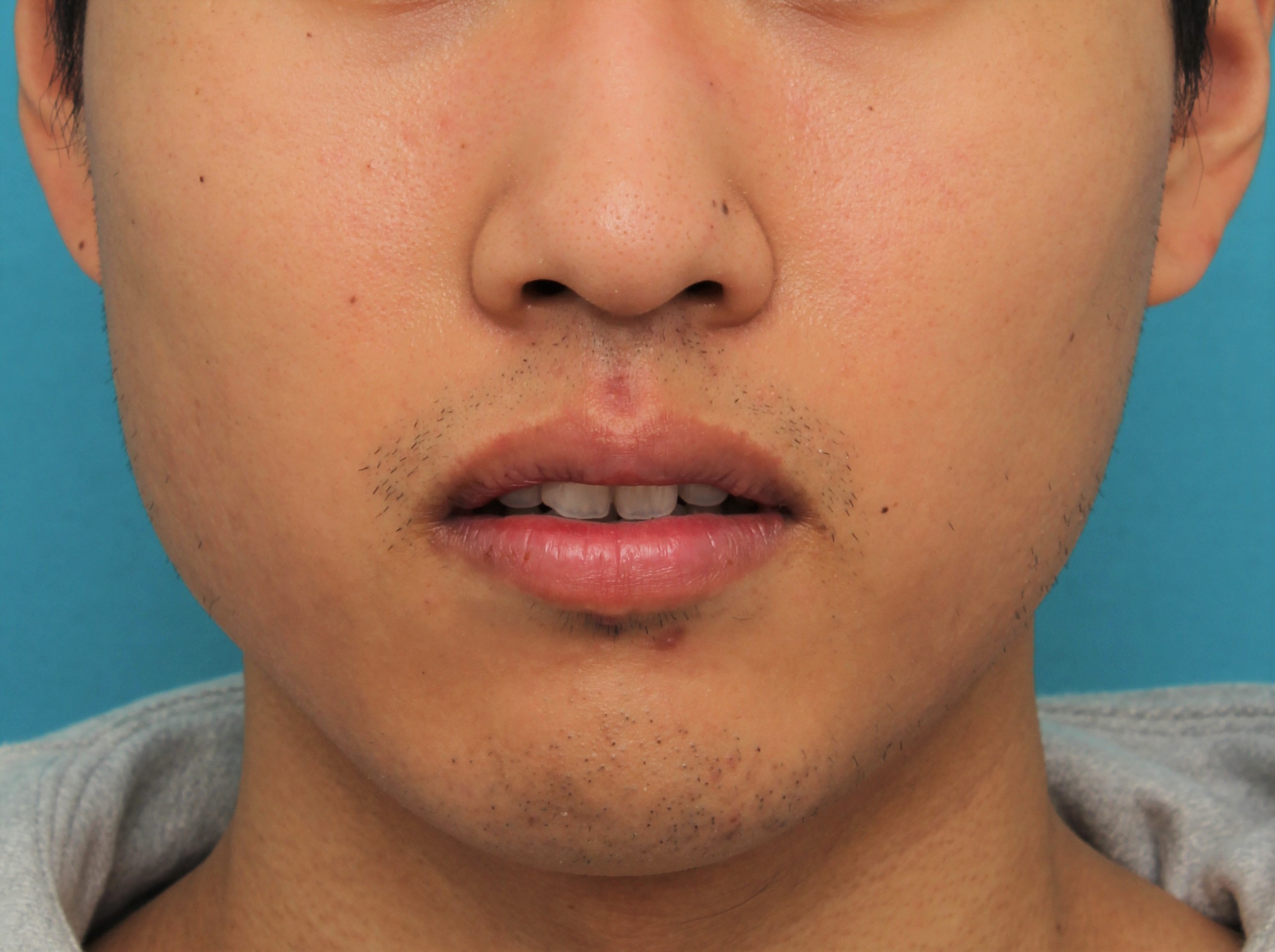 症例写真,手術で上下の唇を薄くした20代男性の症例写真,4ヶ月後,口を半開きにした状態,mainpic_usuku017g.jpg