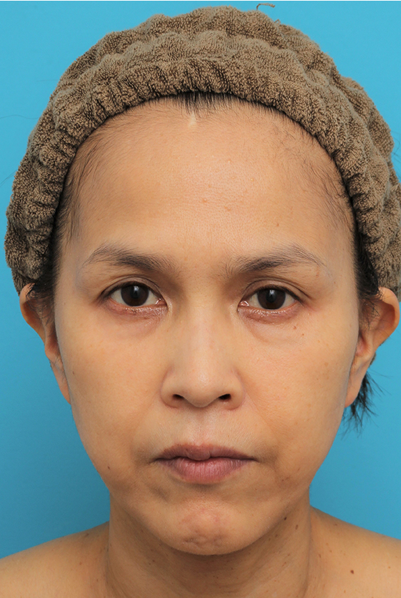 症例写真,ミディアムフェイスリフトを行った50代女性の症例写真,After（6ヶ月後）,ba_mediumlift016_b01.jpg