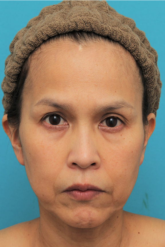 症例写真,ミディアムフェイスリフトを行った50代女性の症例写真,Before,ba_mediumlift016_b01.jpg