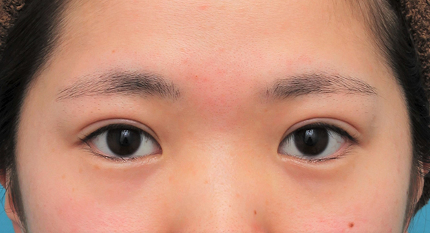 症例写真,二重まぶた全切開法を行った20代女性の症例写真,2ヶ月後,目を開けた状態,mainpic_sekkai075h.jpg