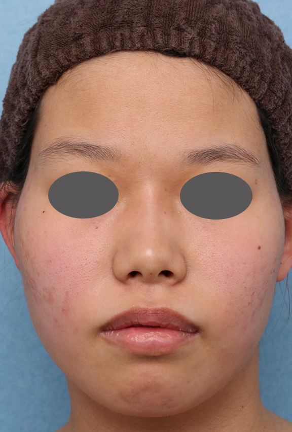 症例写真,鼻筋ヒアルロン酸注射の症例写真,After,ba_ryubi2040_b01.jpg