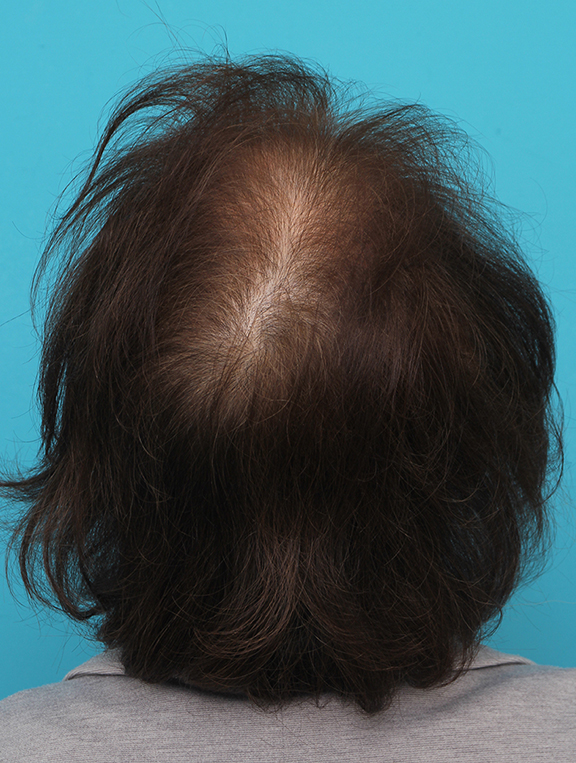 症例写真,女性の薄毛治療の症例写真,Before,ba_aga_josei005_b02.jpg