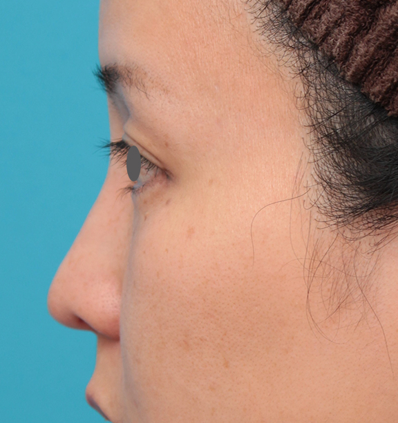 耳介軟骨移植（鼻先を出す）,鼻先に耳介軟骨移植を行った30代女性の症例写真,After（6ヶ月後）,ba_jikai046_b03.jpg