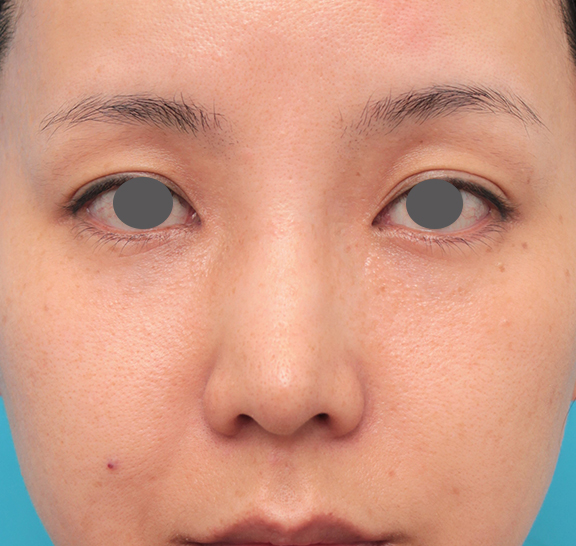症例写真,鼻先に耳介軟骨移植を行った30代女性の症例写真,Before,ba_jikai046_b01.jpg