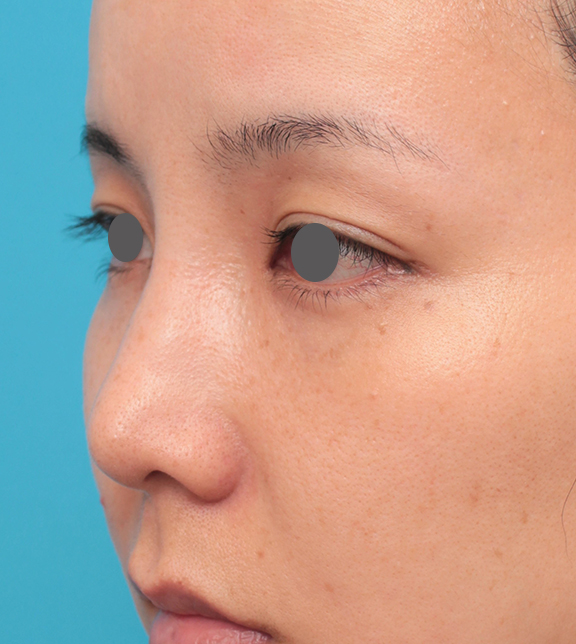 耳介軟骨移植（鼻先を出す）,鼻先に耳介軟骨移植を行った30代女性の症例写真,Before,ba_jikai046_b02.jpg