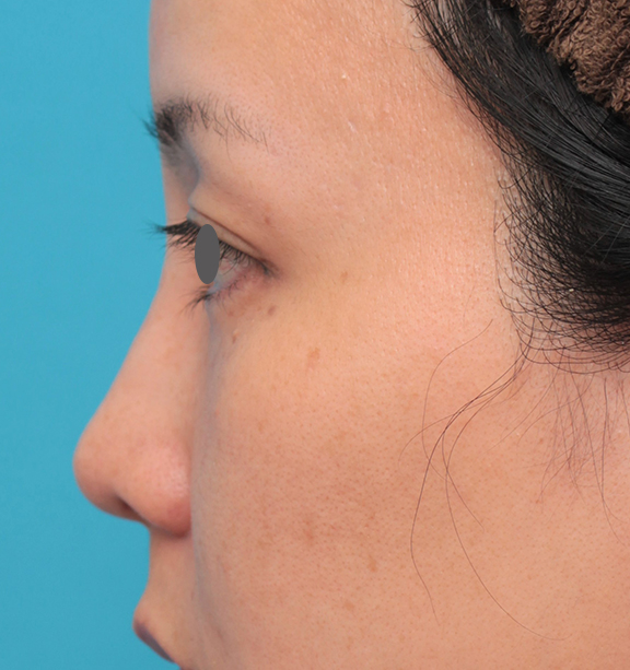 耳介軟骨移植（鼻先を出す）,鼻先に耳介軟骨移植を行った30代女性の症例写真,Before,ba_jikai046_b03.jpg