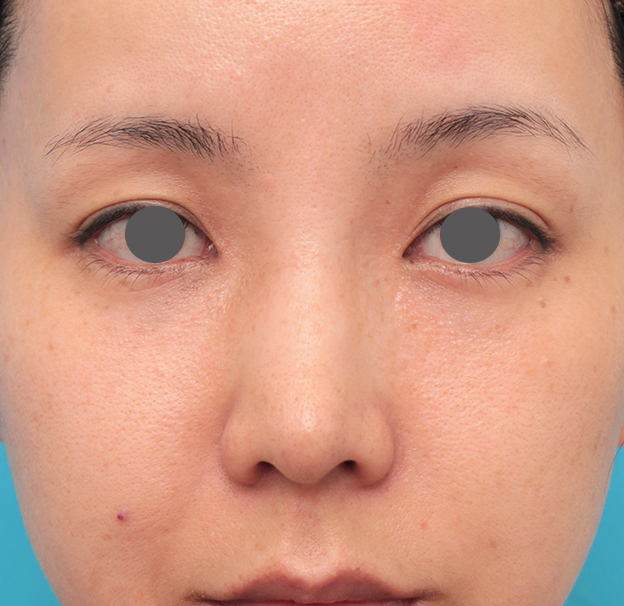 耳介軟骨移植（鼻先を出す）,鼻先に耳介軟骨移植を行った30代女性の症例写真,手術前,mainpic_jikai046a.jpg