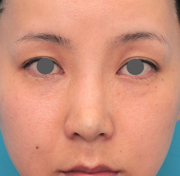 耳介軟骨移植（鼻先を出す）,鼻先に耳介軟骨移植を行った30代女性の症例写真,手術直後,mainpic_jikai046b.jpg