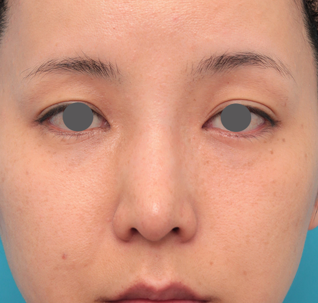 耳介軟骨移植（鼻先を出す）,鼻先に耳介軟骨移植を行った30代女性の症例写真,6日後,mainpic_jikai046c.jpg