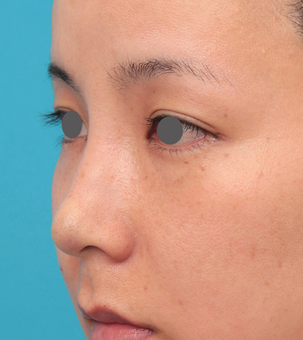 耳介軟骨移植（鼻先を出す）,鼻先に耳介軟骨移植を行った30代女性の症例写真,手術直後,mainpic_jikai046f.jpg