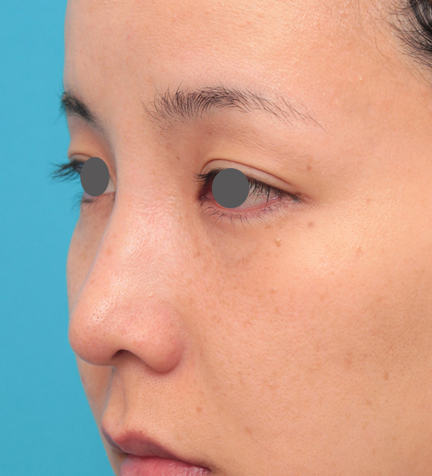 耳介軟骨移植（鼻先を出す）,鼻先に耳介軟骨移植を行った30代女性の症例写真,6日後,mainpic_jikai046g.jpg