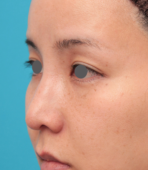 耳介軟骨移植（鼻先を出す）,鼻先に耳介軟骨移植を行った30代女性の症例写真,6ヶ月後,mainpic_jikai046h.jpg