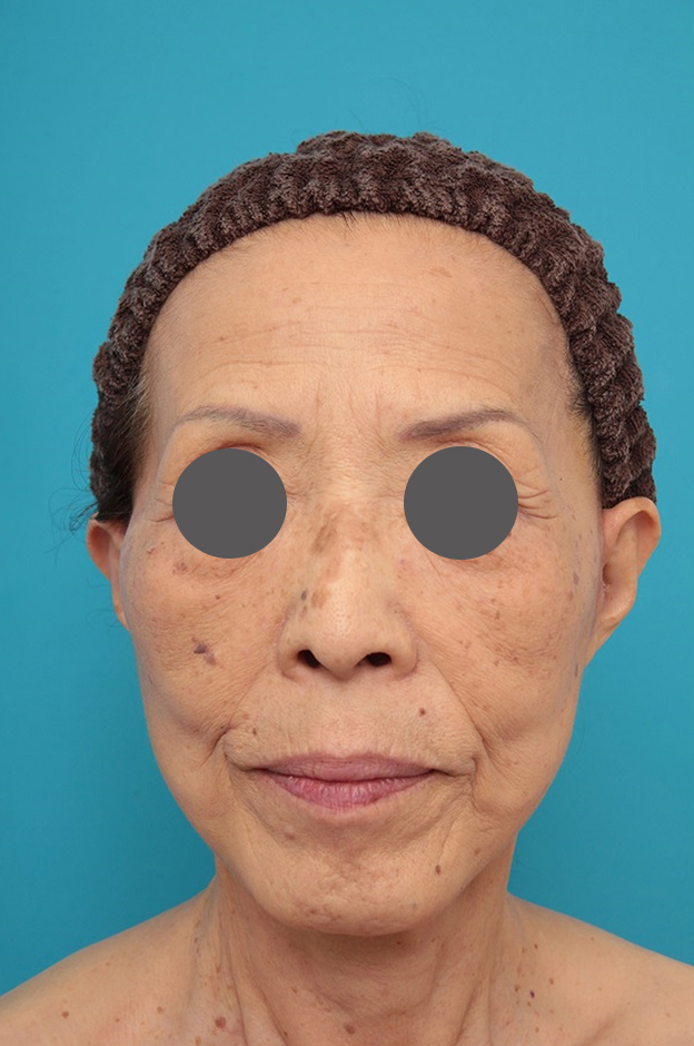 症例写真,ミニフェイスリフトの症例 お顔全体のタルミとシワをリフトアップしたい70代後半女性,1週間後（抜糸時）,mainpic_minilift011b.jpg