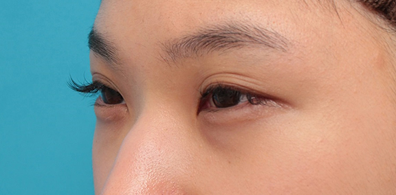 症例写真,全切開二重・目頭切開・垂れ目形成の症例写真,Before,ba_sekkai077_b03.jpg