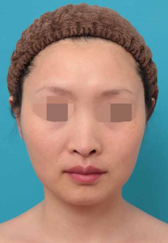 症例写真,鼻中隔延長術の症例写真,After（6ヶ月後）,ba_bichukaku005_b01.jpg