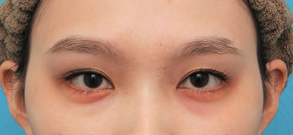 症例写真,目尻切開＋垂れ目形成（グラマラスライン）を行った20代女性の症例写真,After（6ヶ月後）,ba_mejiri023_b01.jpg