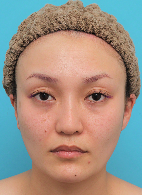 頬骨切り／削り,ボツリヌストキシン注射（エラ、プチ小顔術）,頬骨削り＋エラボツリヌストキシン注射で輪郭を整えた30代女性の症例画像,After（4ヶ月後）,ba_hohobone001_a01.jpg