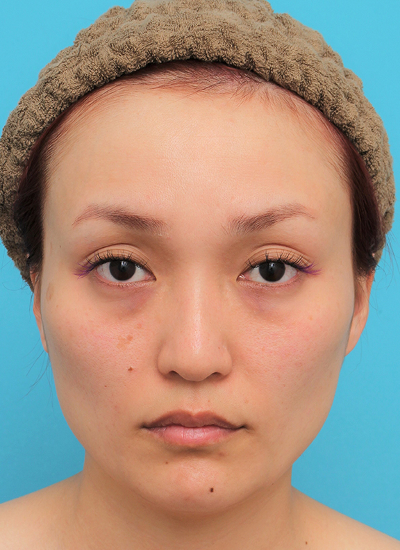 症例写真,頬骨削り＋エラボツリヌストキシン注射で輪郭を整えた30代女性の症例画像,Before,ba_hohobone001_b01.jpg
