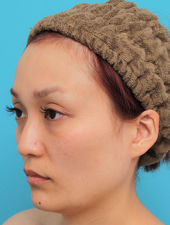 症例写真,頬骨削り＋エラボツリヌストキシン注射で輪郭を整えた30代女性の症例画像,Before,ba_hohobone001_b02.jpg