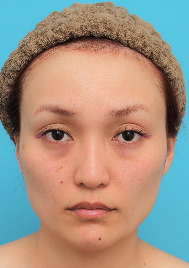 症例写真,頬骨削り＋エラボツリヌストキシン注射で輪郭を整えた30代女性の症例画像,手術前,mainpic_hohobone001a.jpg