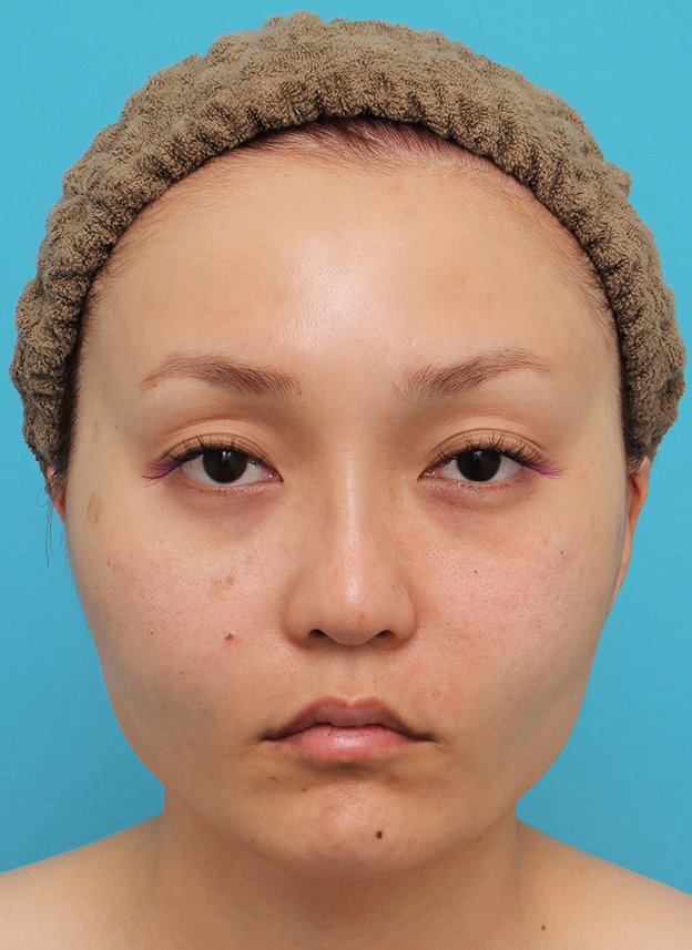 症例写真,頬骨削り＋エラボツリヌストキシン注射で輪郭を整えた30代女性の症例画像,手術直後,mainpic_hohobone001b.jpg