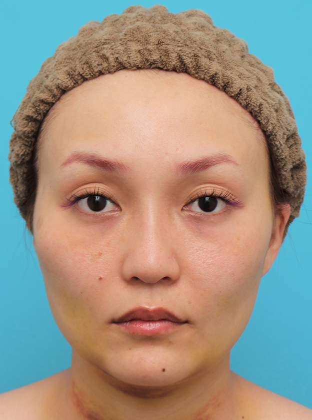 症例写真,頬骨削り＋エラボツリヌストキシン注射で輪郭を整えた30代女性の症例画像,1週間後,mainpic_hohobone001c.jpg