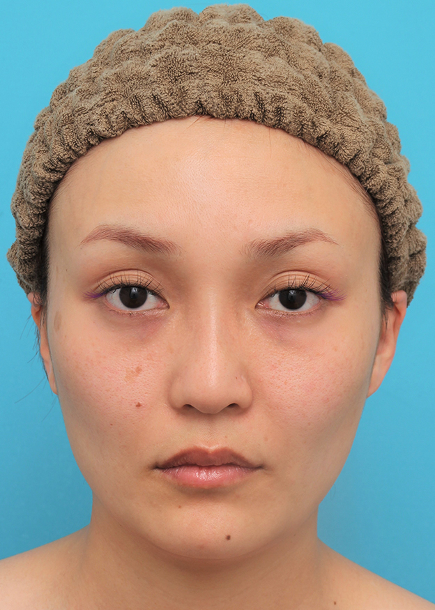 症例写真,頬骨削り＋エラボツリヌストキシン注射で輪郭を整えた30代女性の症例画像,3週間後,mainpic_hohobone001d.jpg
