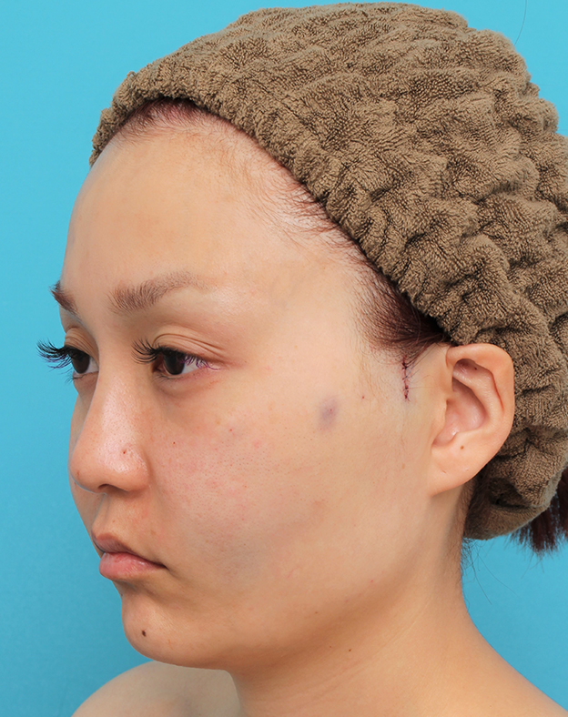 症例写真,頬骨削り＋エラボツリヌストキシン注射で輪郭を整えた30代女性の症例画像,手術直後,mainpic_hohobone001g.jpg