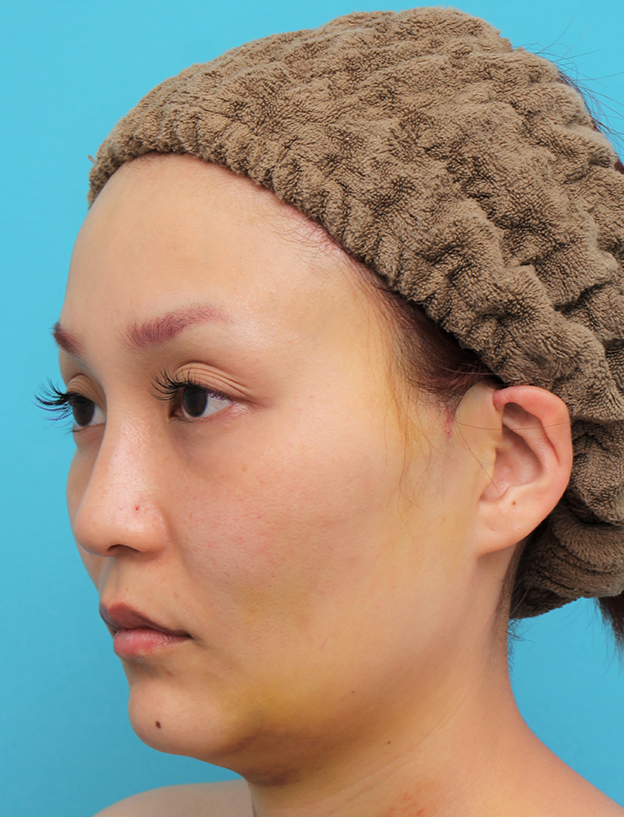 症例写真,頬骨削り＋エラボツリヌストキシン注射で輪郭を整えた30代女性の症例画像,1週間後,mainpic_hohobone001h.jpg