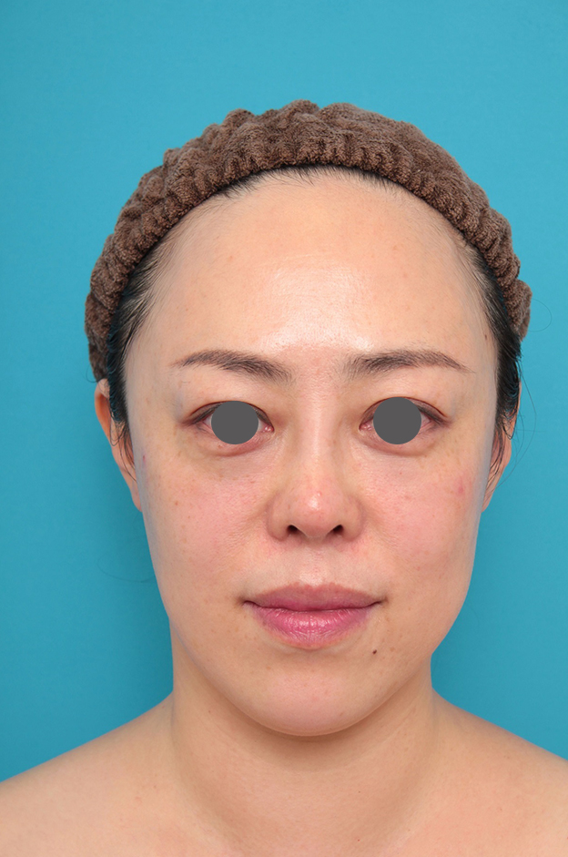 症例写真,鼻プロテーゼ、耳介軟骨移植の症例写真,1ヶ月後,mainpic_ryubi1058c.jpg