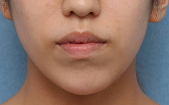 顎の長期作用型ヒアルロン酸注射の症例写真,After,ba_agochu018_a01.jpg