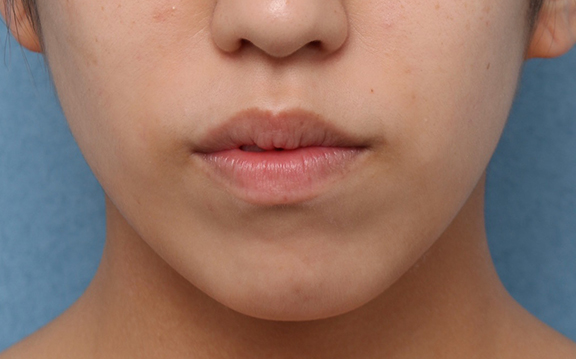 症例写真,顎の長期作用型ヒアルロン酸注射の症例写真,Before,ba_agochu018_b01.jpg