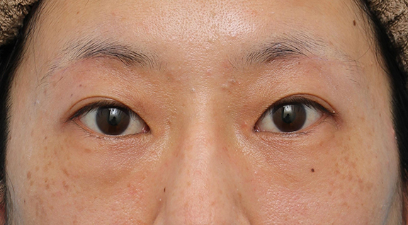 症例写真,眉下リフト（上眼瞼リフト） の症例写真,After（1ヶ月後）,ba_jougankenlift012_b01.jpg