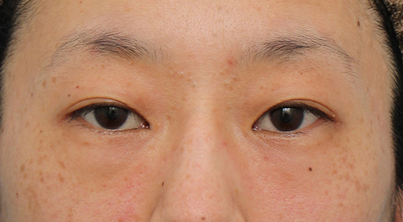 症例写真,眉下リフト（上眼瞼リフト） の症例写真,Before,ba_jougankenlift012_b01.jpg