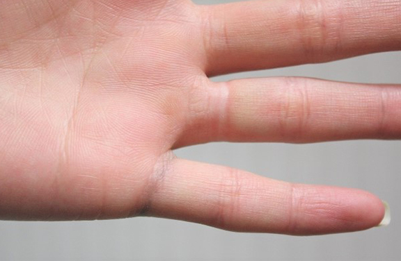指輪の模様の入れ墨のレーザー治療の症例写真,After（ レーザー治療後2ヶ月）,ba_irezumi037_a01.jpg