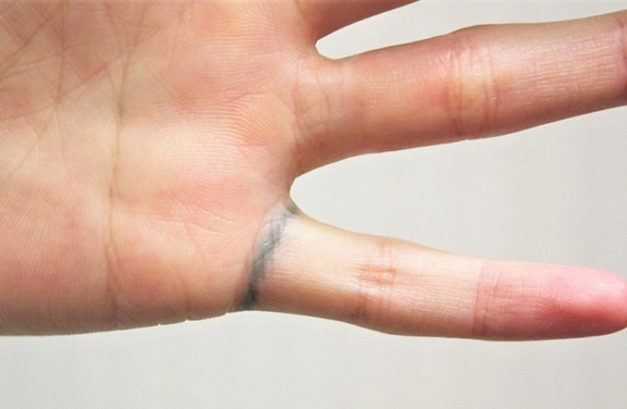 症例写真,指輪の模様の入れ墨のレーザー治療の症例写真,Before,ba_irezumi037_b01.jpg