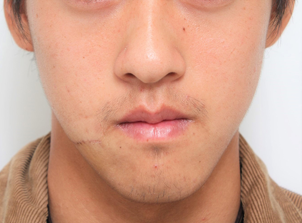 症例写真,顔の傷痕を修正手術した20代男性の症例写真,1週間後,mainpic_keisei001c.jpg