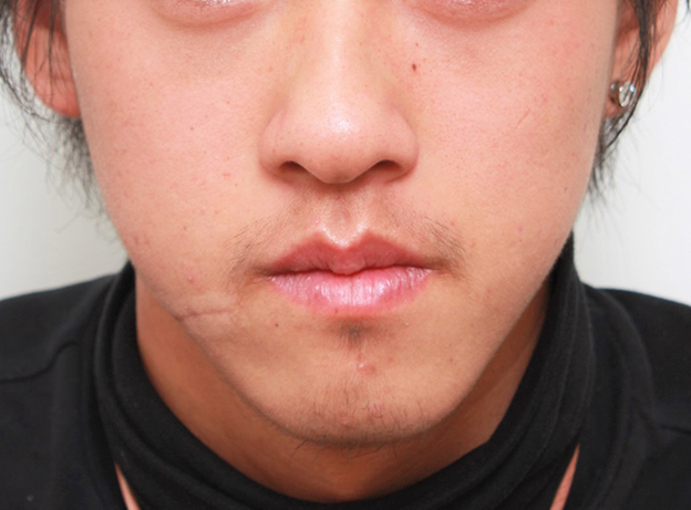 症例写真,顔の傷痕を修正手術した20代男性の症例写真,2ヶ月後,mainpic_keisei001d.jpg
