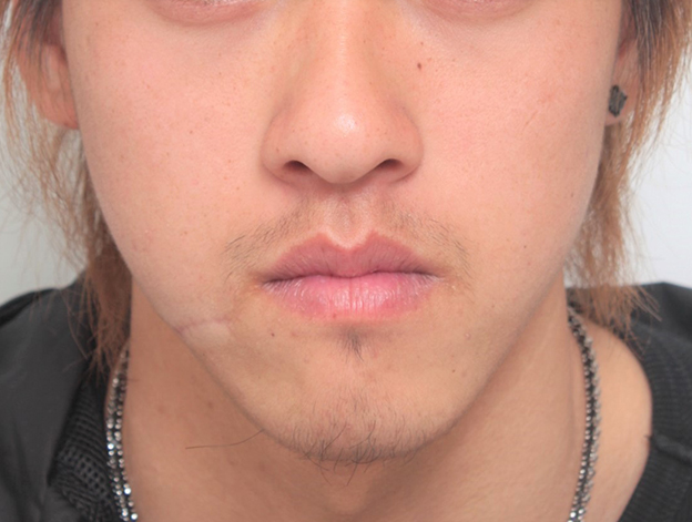 症例写真,顔の傷痕を修正手術した20代男性の症例写真,4ヶ月後,mainpic_keisei001e.jpg
