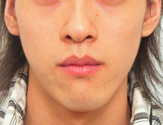 症例写真,顔の傷痕を修正手術した20代男性の症例写真,2年後,mainpic_keisei001f.jpg