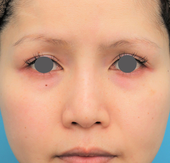 症例写真,隆鼻術（シリコンプロテーゼ）の症例 エンドプロテーゼ除去/シリコンプロテーゼ挿入,After（6ヶ月後）,ba_ryubi1060_b01.jpg