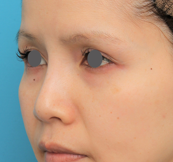 症例写真,鼻のエンドプロテーゼを除去するのと同時にシリコンプロテーゼを入れた症例写真,After（6ヶ月後）,ba_ryubi1060_b02.jpg