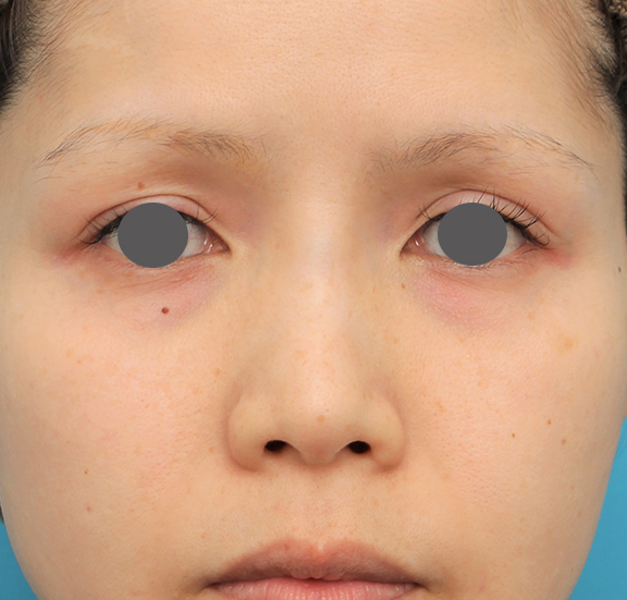 隆鼻術（シリコンプロテーゼ）の症例 エンドプロテーゼ除去/シリコンプロテーゼ挿入,Before,ba_ryubi1060_b01.jpg