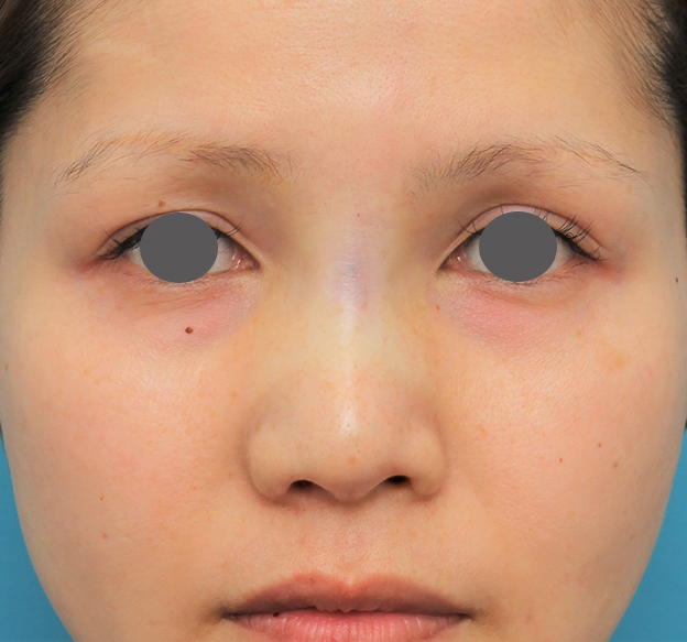 症例写真,鼻のエンドプロテーゼを除去するのと同時にシリコンプロテーゼを入れた症例写真,手術直後,mainpic_ryubi1060b.jpg