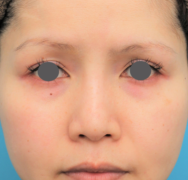 症例写真,隆鼻術（シリコンプロテーゼ）の症例 エンドプロテーゼ除去/シリコンプロテーゼ挿入,6ヶ月後,mainpic_ryubi1060d.jpg