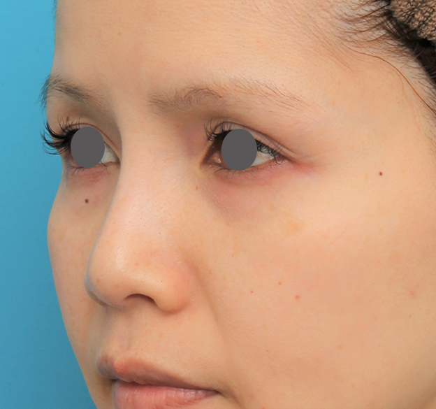 症例写真,鼻のエンドプロテーゼを除去するのと同時にシリコンプロテーゼを入れた症例写真,6ヶ月後,mainpic_ryubi1060h.jpg